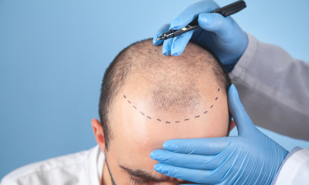 Hair Transplant Procedure